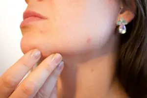 8 Treatments for Pimples Due to Stress