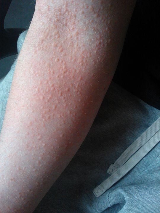 Can You Get Hives On Your Legs From Stress