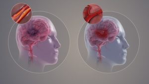 Can stress cause a stroke? Heart health 101