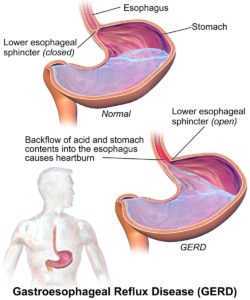 Can stress cause acid reflux - Avoid the Pitfalls