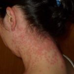 Stress Rash – Treatment and 6 Prevention Tips