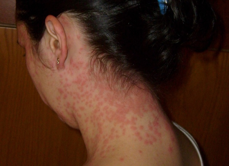 Stress Rash – Treatment and 6 Prevention Tips