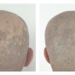 Stress Induced Alopecia - 3 hair loss stress types