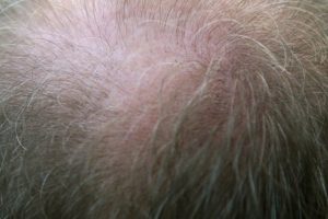 Stress Induced Alopecia - 3 hair loss stress types