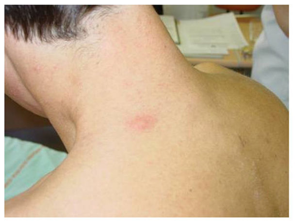 Stress Rash on Neck – 4 Things to Know - Negative Stress