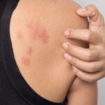 Reducing Family Conflict to Avoid Stress Hives